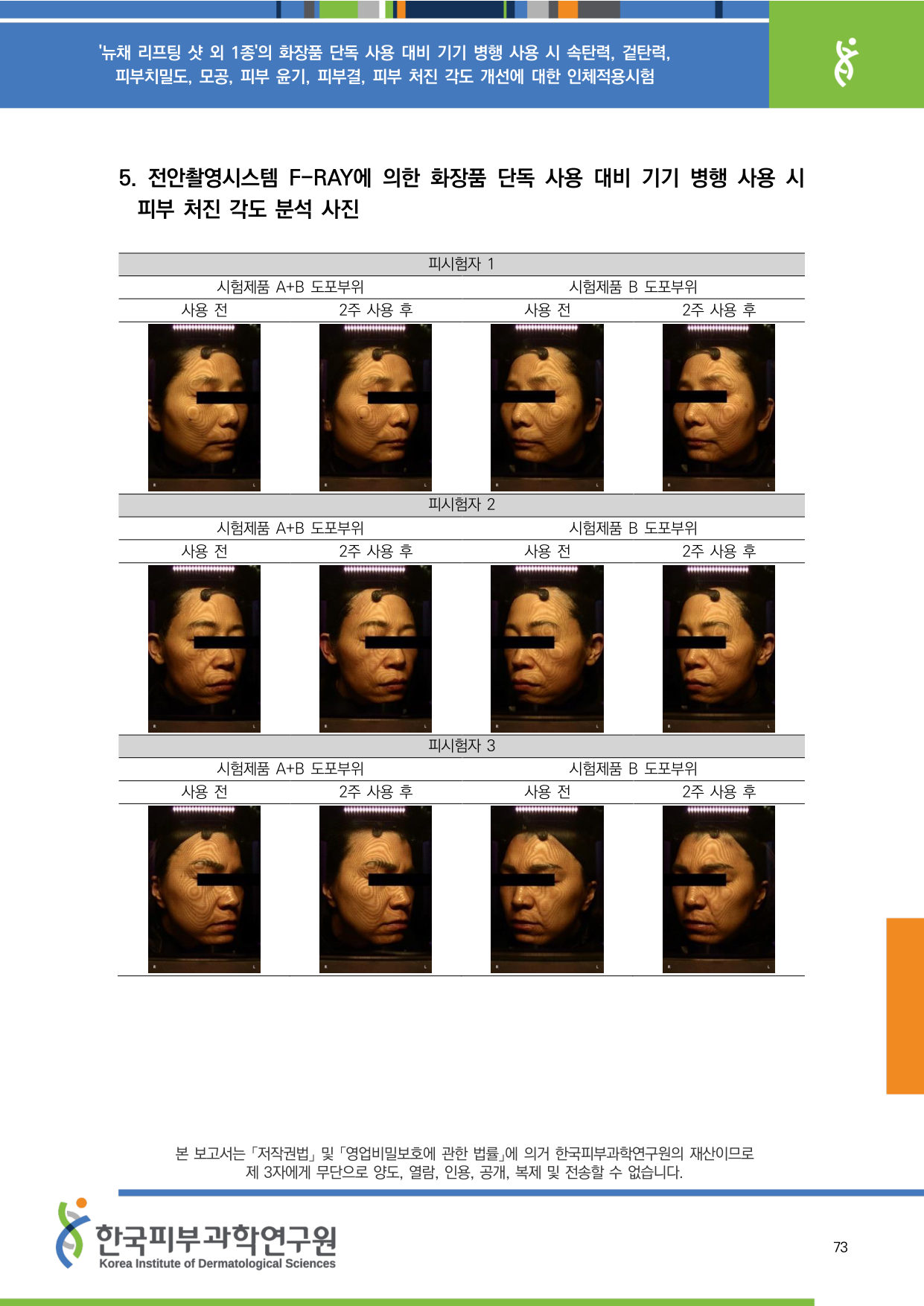 F-RAY 처짐 1-3